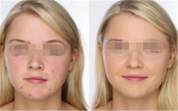 成都銅雀臺鼻綜合矯正，告別不滿意的鼻型！