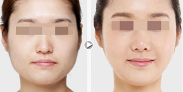 揭秘南京3D精微祛眼袋整形機構(gòu)實力榜單