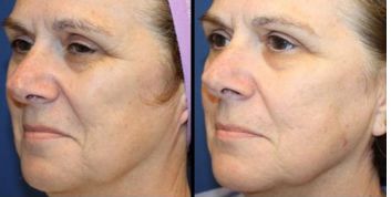 昆明玻尿酸填充眼周細紋，哪幾家醫(yī)院值得信賴？