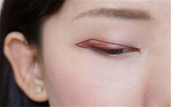 注射瘦腿的價(jià)格是由哪些因素影響的？