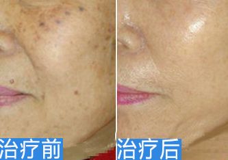 濟(jì)南做眼袋哪家醫(yī)院好？專家推薦濟(jì)南當(dāng)?shù)仨敿壯鄞中g(shù)醫(yī)院