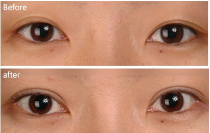 威海魚尾紋微創(chuàng)提升：十大口碑醫(yī)院體驗(yàn)評(píng)估