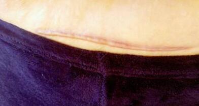 臉部削骨手術(shù)貴嗎？潮流的臉部削骨手術(shù)帶來了哪些改變