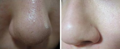 鄭州隆鼻手術(shù)哪家醫(yī)院好？選對醫(yī)院，打造完美鼻型！