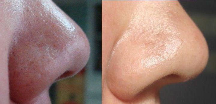 北京胎記治療醫(yī)院哪家好？探尋北京專(zhuān)業(yè)胎記治療醫(yī)院排名及成功案例