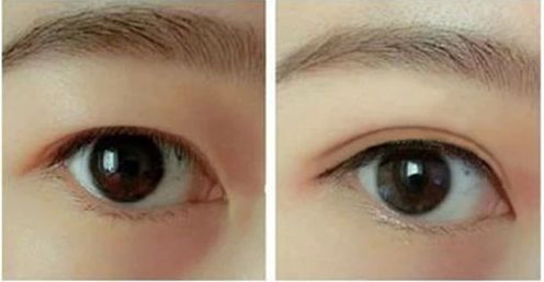 南京醫(yī)院韓式雙眼皮技術(shù)哪家最靠譜？