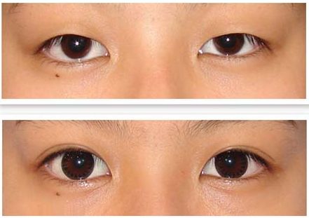 包頭哪家整形醫(yī)院做假體鼻子好？一起來搜一下！