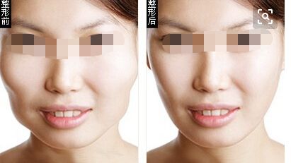 武漢雙下巴注射塑形醫(yī)院口碑排行前十