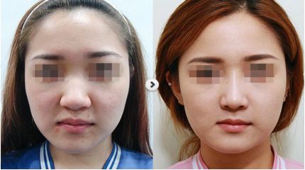 重慶華美整形醫(yī)院眼鼻整形美容：選擇李超醫(yī)生，完美塑造理想鼻型