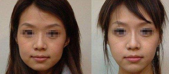 杭州鼻唇溝膠原蛋白注射整形醫(yī)院推薦榜單