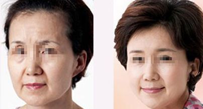 東莞黑眼圈超聲祛除：權(quán)威醫(yī)院口碑盤點(diǎn)數(shù)單