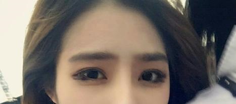 雙眼皮恢復(fù)需要多久？恢復(fù)受哪些因素影響？