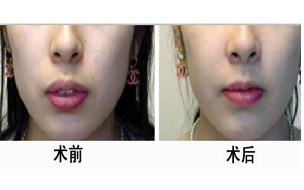 西美趙永政隆胸有哪些效果？整形術后能實現(xiàn)豐胸嗎？