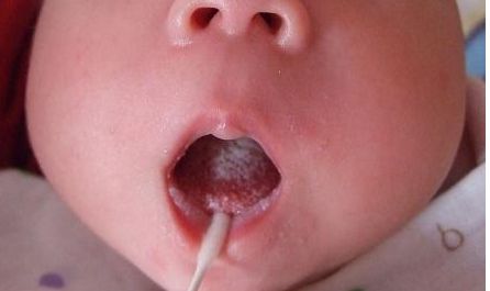 長(zhǎng)春去胎記哪家醫(yī)院好？專家推薦的最佳醫(yī)院是哪家？