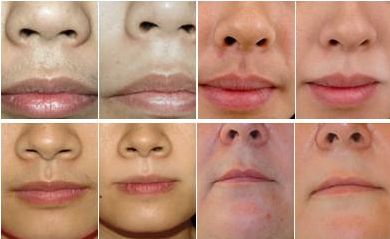 【西寧雙眼皮割哪家醫(yī)院好？專業(yè)醫(yī)師推薦】