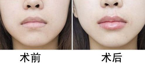 上海做雙眼皮，哪家醫(yī)院好？專業(yè)醫(yī)院推薦