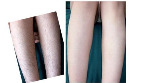 杭州激光祛痘醫(yī)院排名和費(fèi)用對(duì)比，哪家醫(yī)院激光祛痘好？