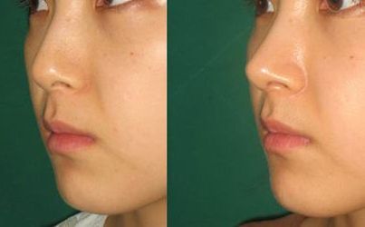 劉憲華整容傳聞揭秘：真相到底如何？