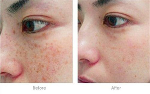 隆胸有哪些方式？效果能保持多久？需要注意哪些問題？