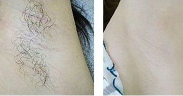 尋找珠海最受歡迎的鼻子整形醫(yī)院，告訴你珠海鼻子整形去哪家好