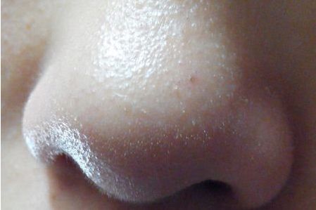 常州哪家醫(yī)院去眼袋效果好？眼袋怎么去除最有效？