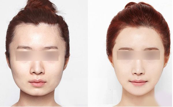 哈爾濱超贊微創(chuàng)眼部除皺，前十佳醫(yī)院測評幫你變美