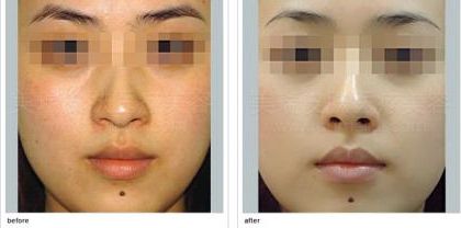 石家莊嗨體川字紋醫(yī)院口碑排行榜前十，你該如何選擇？