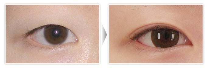 鼻翼頭整形手術(shù)多值得嗎？術(shù)后需要特別注意哪些事項？