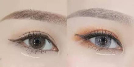 玻尿酸墊下巴可以在多久后恢復自然？了解玻尿酸是什么？玻尿酸墊下巴后會長期有效嗎？