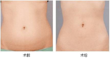 杭州木偶紋整形醫(yī)院哪家正規(guī)？2023年排名前幾值得推薦！