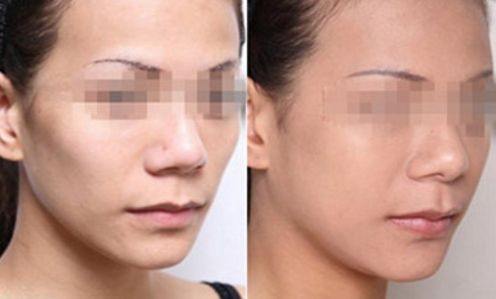 杭州膨體隆胸整形醫(yī)院排行榜top10大揭秘！