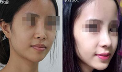 南京點(diǎn)陣激光祛除靜態(tài)紋權(quán)威醫(yī)院推薦