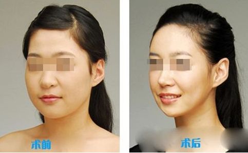 滕州水光針法令紋醫(yī)院排行榜TOP10，哪家專業(yè)又可信？