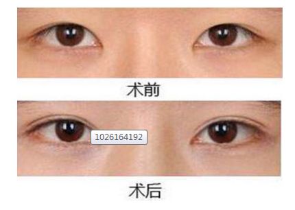 徐子淇是否真的進行了整容手術：揭秘她真實的美麗背后