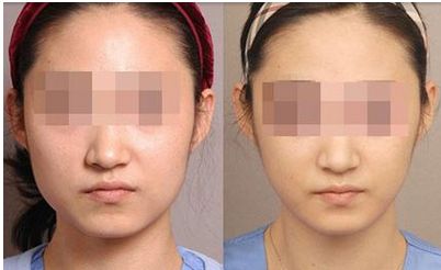 杭州眼部整形祛除眼紋醫(yī)院排行