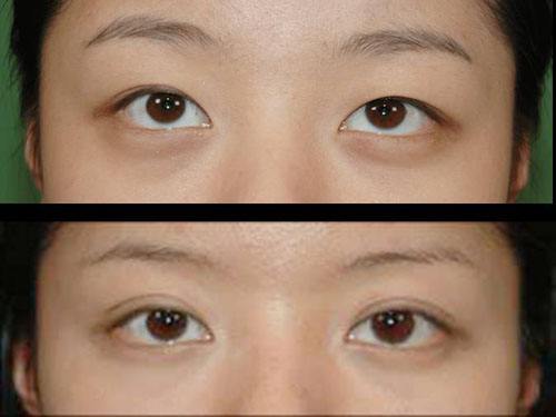 廣元哪家醫(yī)院去除川字紋的效果好？2023年很受歡迎的微創(chuàng)手術(shù)整形醫(yī)院排行榜