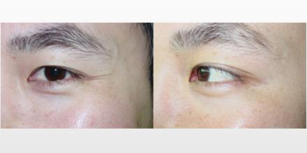 如何通過注射療法來瘦小腿？為什么要避開果酸注射瘦腿方法？