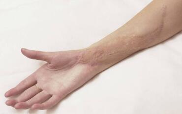 假體隆鼻整形價格是不是很高？效果好嗎？看看有經(jīng)驗的人怎么說~