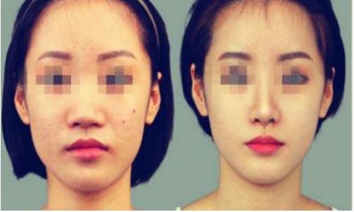 昆明眶隔脂肪釋放手術(shù)哪家醫(yī)院好？口碑評價(jià)揭秘！