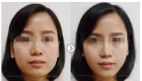 株洲自體脂肪填充川字紋口碑和實(shí)力超群的美容醫(yī)院推薦