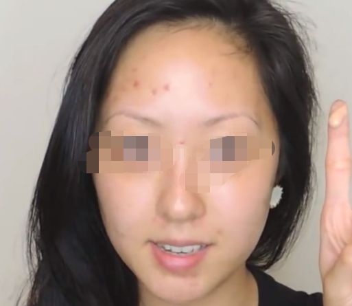 重慶消除魚尾紋凹陷前10家好評如潮整形機構大評比