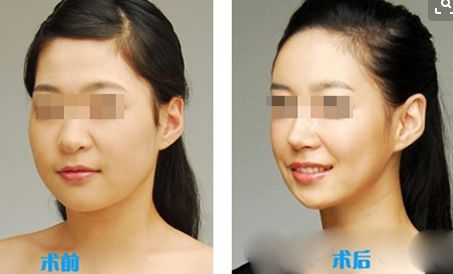 上海頸紋祛除哪家醫(yī)院口碑比較好？排行榜前十強推薦