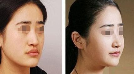 深圳面部溶脂美容醫(yī)院排行榜：告別雙下巴，打造精致小V臉