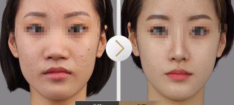 如何確定縮鼻頭手術(shù)費(fèi)用？手術(shù)風(fēng)險(xiǎn)和后遺癥全面解析！