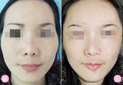 廣州上眼角提升不容錯過！權(quán)威專家推薦十佳醫(yī)美機(jī)構(gòu)