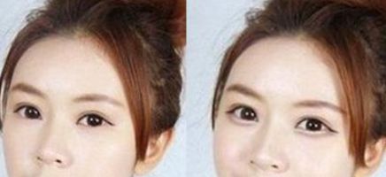 男士頭發(fā)種植是否有危害？了解男性脫發(fā)手術(shù)前必知