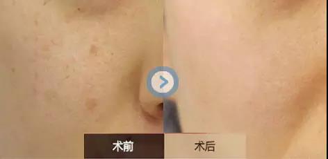 2023張家港蘋果肌復(fù)位提升前十強醫(yī)院，哪幾家值得選擇？讓您肌膚回復(fù)細膩緊致！