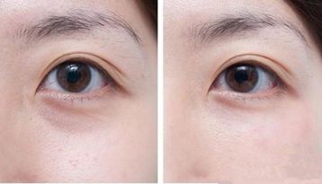 沈陽哪家醫(yī)院做雙眼皮效果好？
