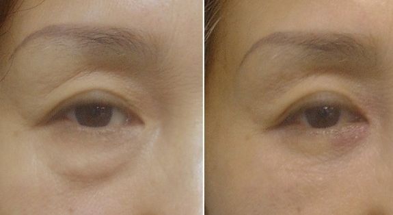 濟(jì)南哪家醫(yī)院做雙眼皮效果好？愛容與海峽口碑優(yōu)勢凸顯!