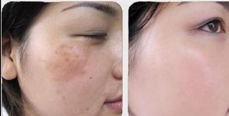 濰坊哪家醫(yī)院的光子嫩膚效果好